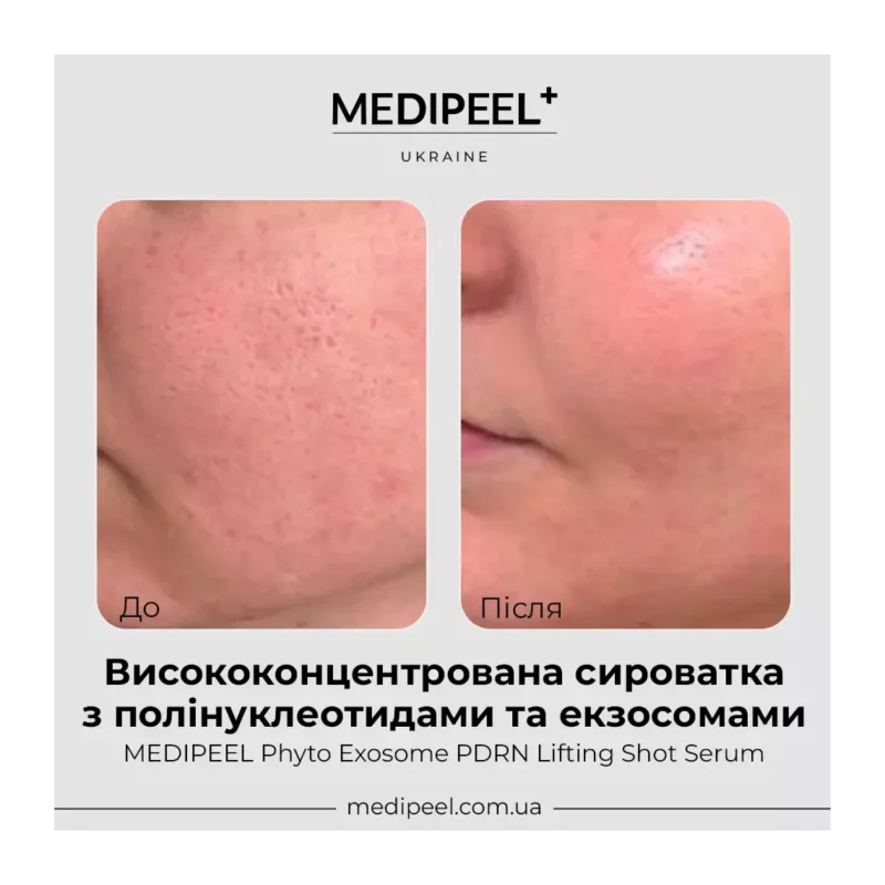 Антивікова ліфтинг-сироватка з PDRN та екзосомами Medi Peel Exosome PDRN Lifting, 50 ml